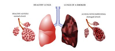 A diagram of the lungs and their stages.