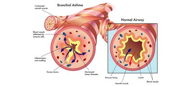 A diagram of bronchial asthma and normal airways.